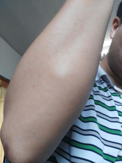手提重物胳膊腫
